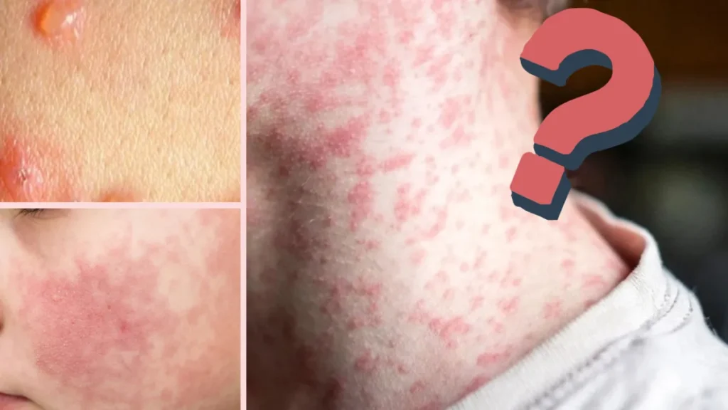 Sarampión, varicela y rubéola: diferencias, síntomas y esquema de vacunación en México