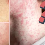 Sarampión, varicela y rubéola: diferencias, síntomas y esquema de vacunación en México