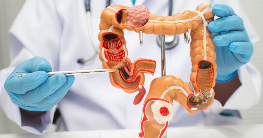 Día Mundial contra el Cáncer de Colon llama a la detección temprana para salvar vidas