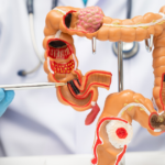 Día Mundial contra el Cáncer de Colon llama a la detección temprana para salvar vidas