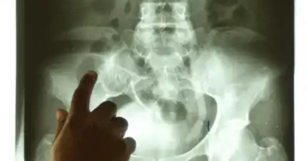 Orina con sangre podría ser señal de alerta: especialistas llaman a no ignorar este síntoma